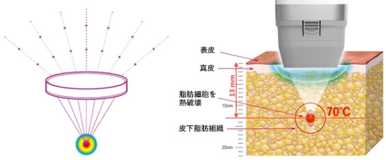 HIFU(ハイフ)テクノロジーのイメージ画像